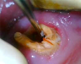 tratamento odontologico registrado por camera intraoral