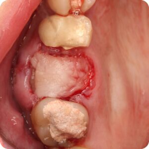 Necessidade de tratamento bucal evidenciada por IntraCam H5 da ActiveWare
