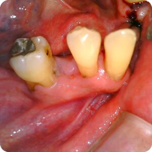 Imagem intrabucal feita por câmera intraoral activeware