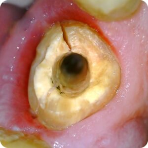 Imagem intraoral capturada por câmera com zoom de 50x